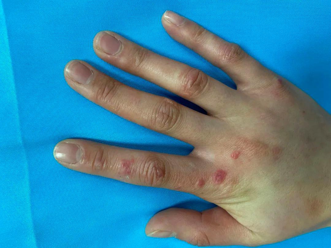 冻疮高发季怎么处理,冬季皮肤长冻疮怎么办