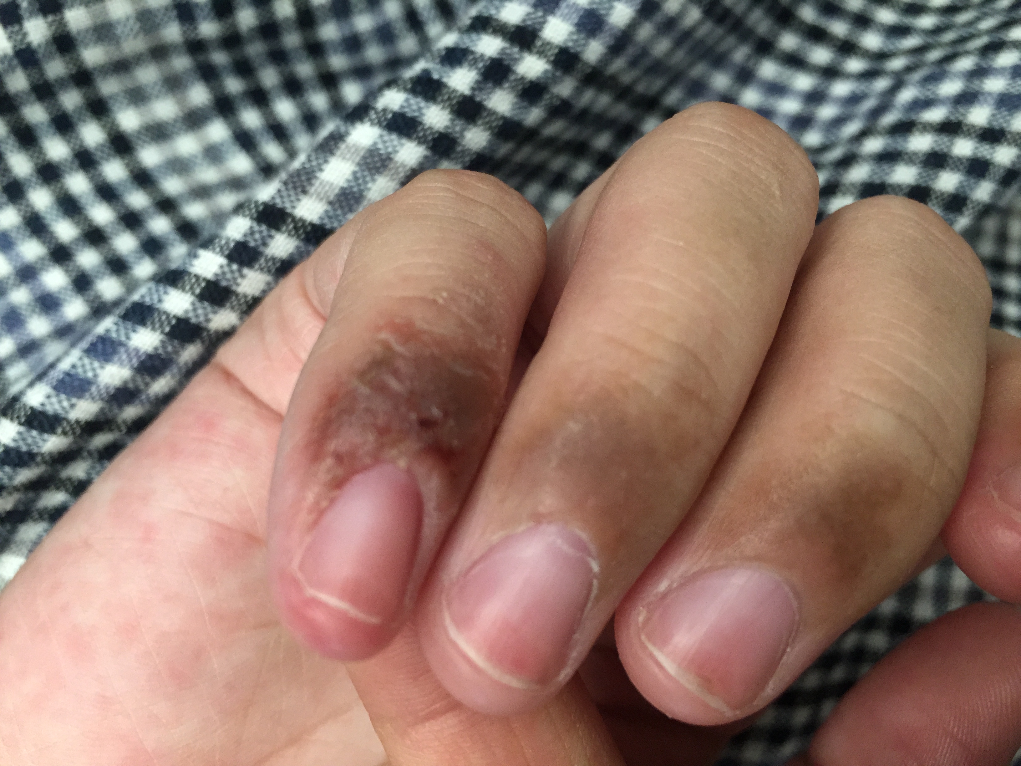 炎症后皮肤黑黑的,怎么办?