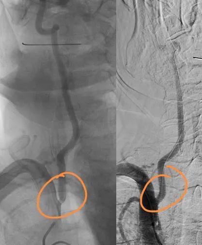 一例头痛头晕患者个案护理,患者出现头晕一侧眼睛看不清