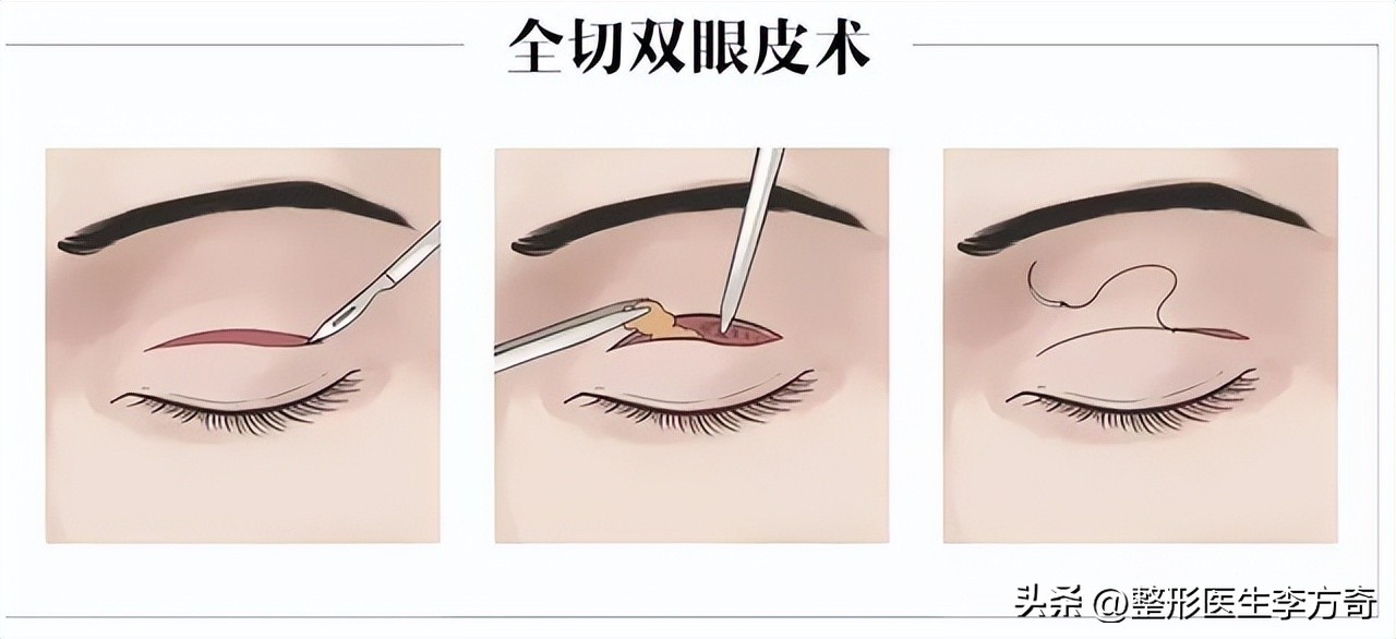 整形医院说双眼皮有几种技术,整形医生如何进行手术