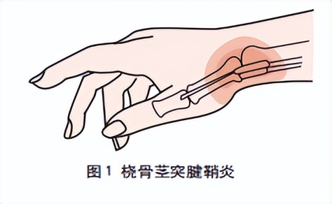 鼠标手、扳机指、键盘手、妈妈手……都是这个病