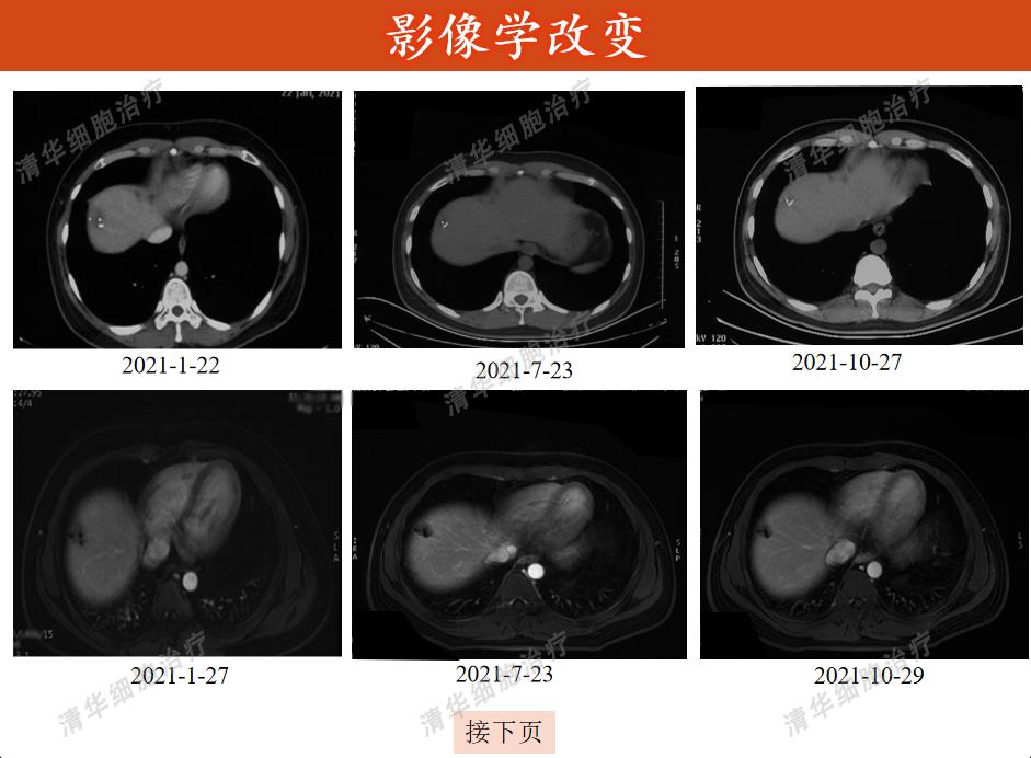 结肠癌术后化疗方案的制定策略,结肠癌手术后热灌注化疗能根治吗