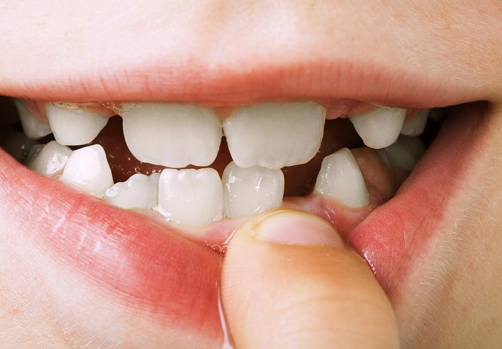 孩子长的兔子牙导致嘴唇突出矫正,孩子牙地包天需要矫正吗