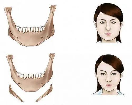 下颌角比较突出怎么改善,下颌问题是什么