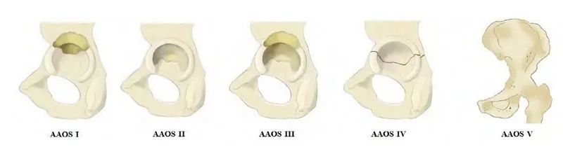 人工髋关节翻修术,人工髋关节翻修能翻修多少次