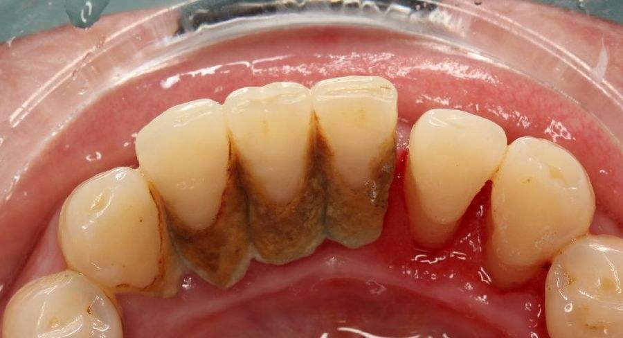 牙结石可以自己抠掉吗教你几招,牙结石自己可以抠掉吗教你小窍门