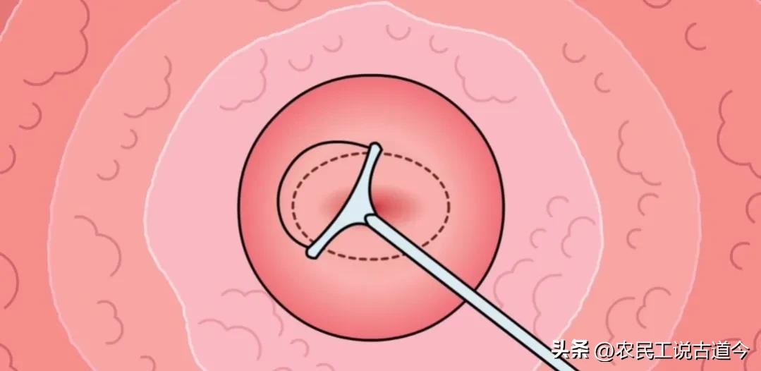 宫颈活检结果和锥切病理结果区别,宫颈活检结果报告减号