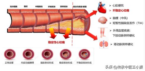 冠心病、心绞痛，1个古方，温阳化湿，散去寒凝，血流通畅心不痛