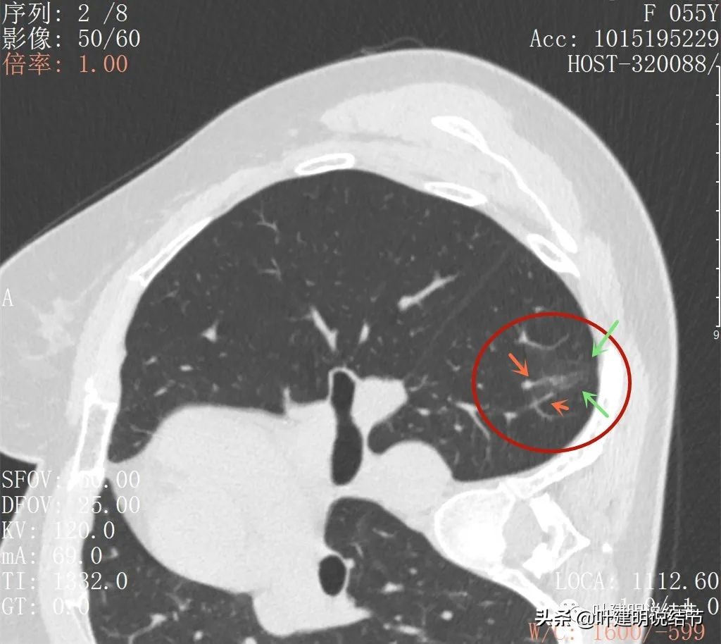 病例分享：这种样子的错构瘤？我是第一次见