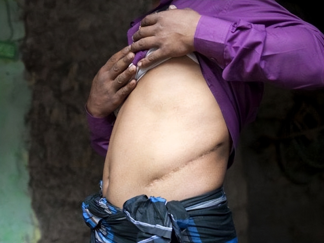 尼泊尔单肾村的故事,尼泊尔单肾村