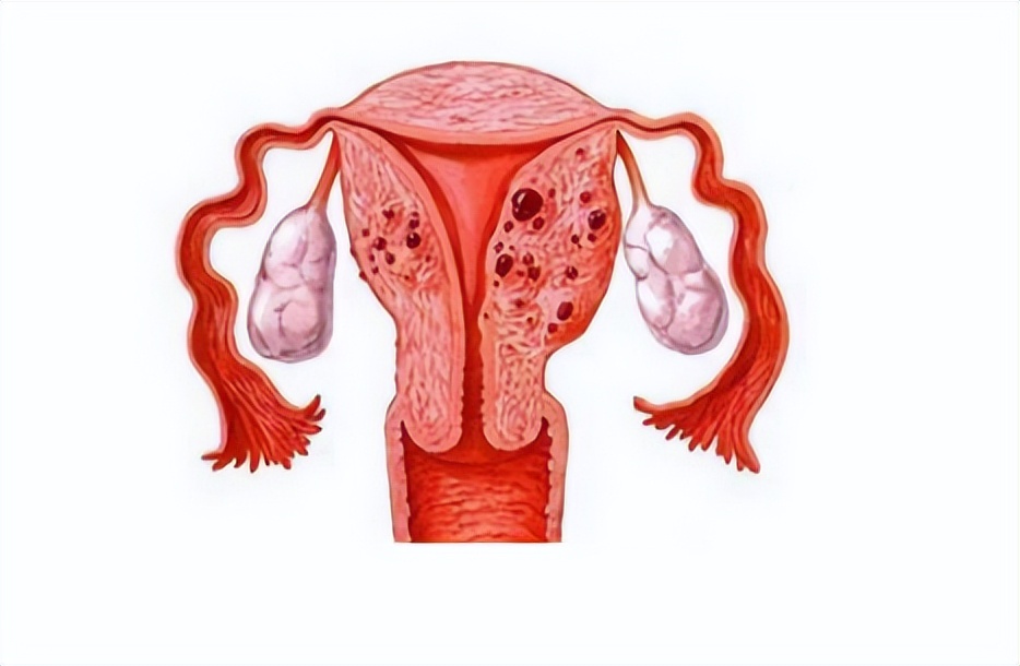 月经“堵”在阴道大半年，积了一瓶矿泉水那么多