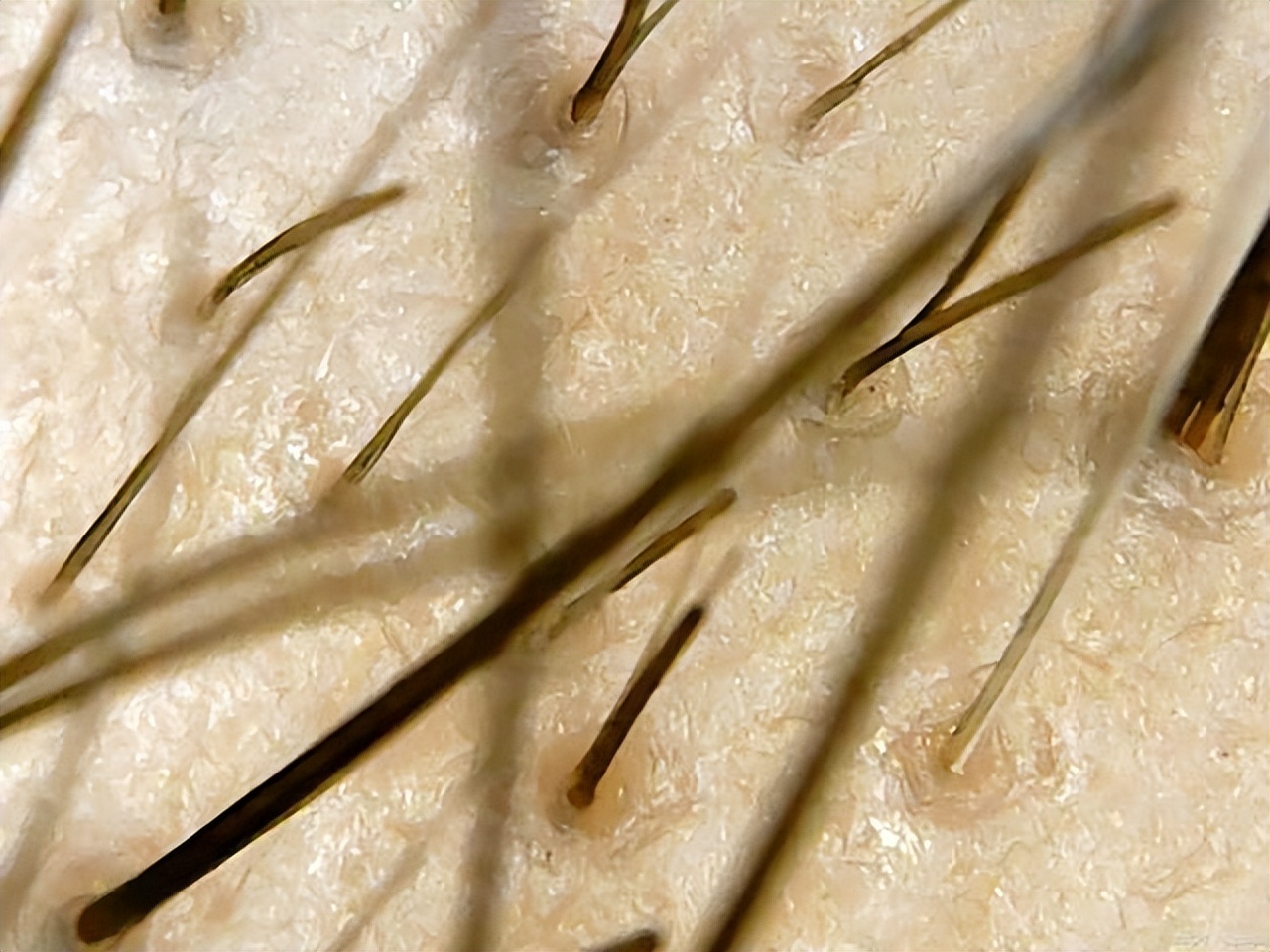 女性毛发容易掉落,什么原因会导致毛发脱落