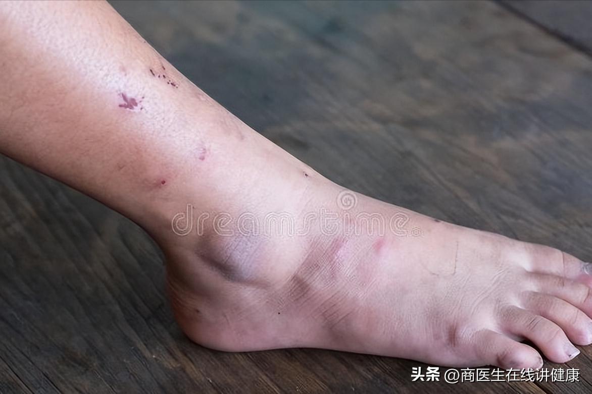 怎样防止糖尿病足,糖尿病足出现三种情况要注意了