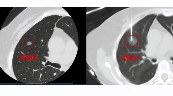 120万一针杀死癌细胞的方法,一针冻死癌细胞多少钱