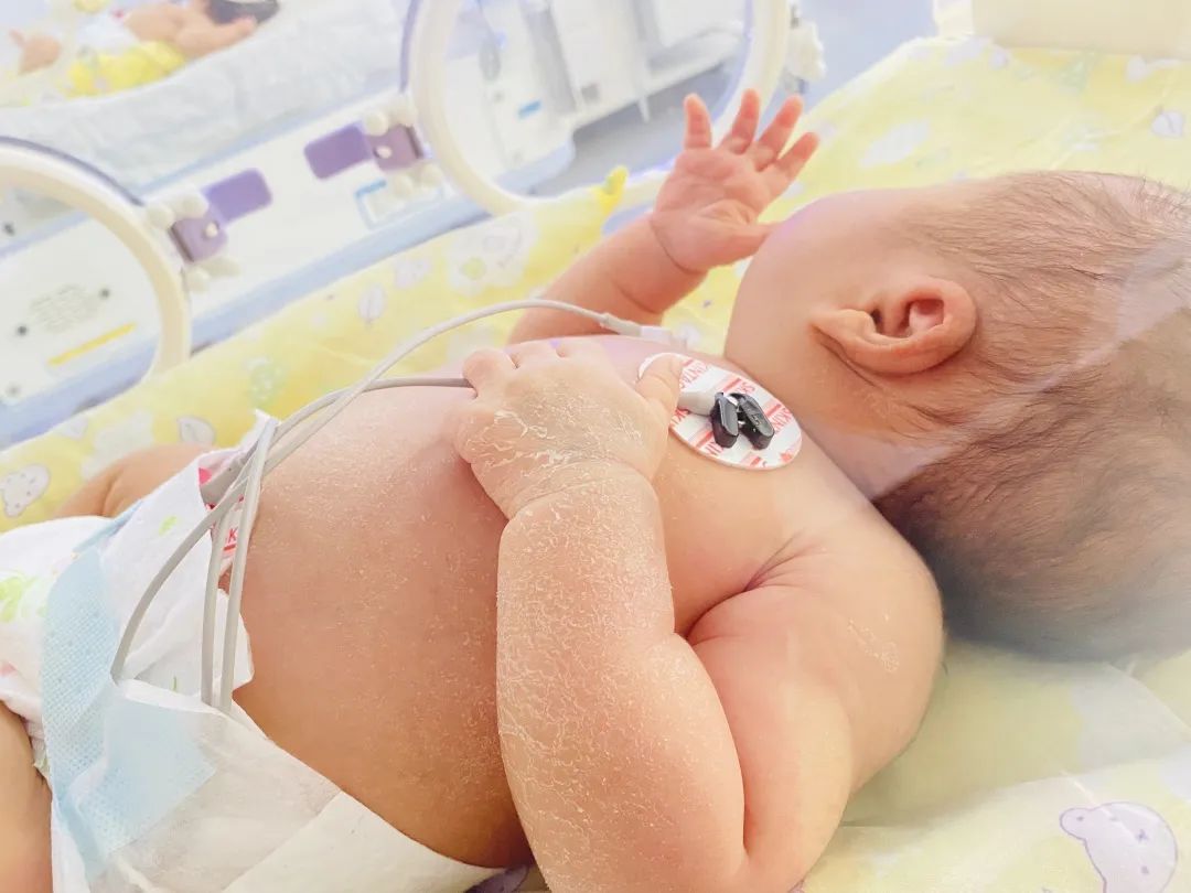 新生宝宝为啥会脱皮,身上脱皮是缺什么维生素