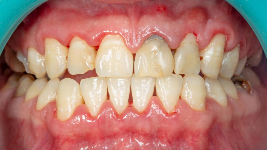 解决牙缝塞牙的办法,牙缝每天都塞牙怎么办