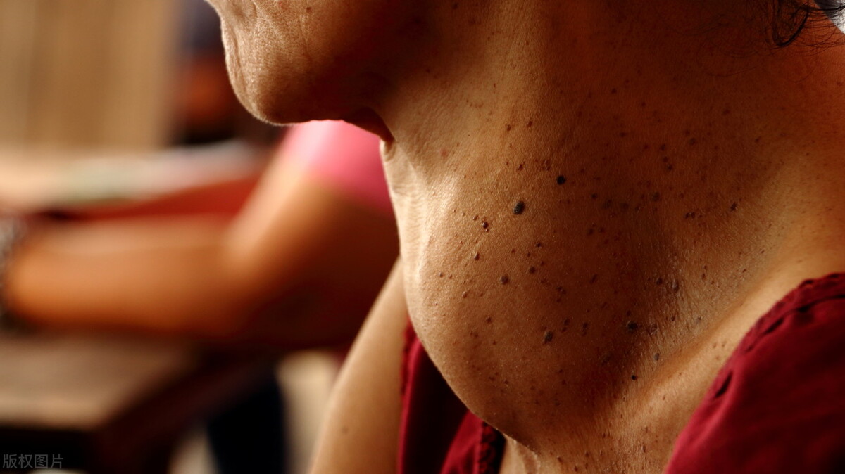 为什么得甲状腺疾病不能吃海鲜,为啥甲状腺疾病不能吃海鲜