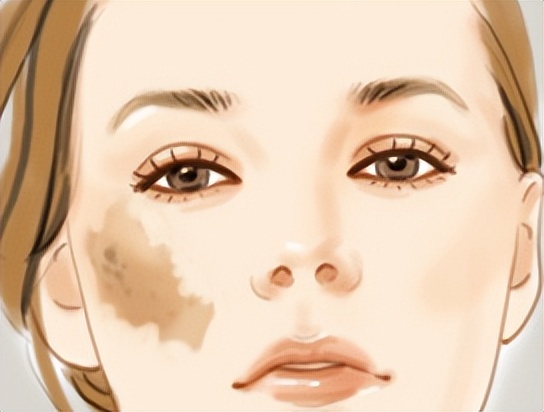 咖啡斑最佳消除年龄,婴儿咖啡斑可以消除吗