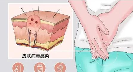 尖锐性湿疣会不会传染给家人,尖锐性湿疣是不是传染给家人