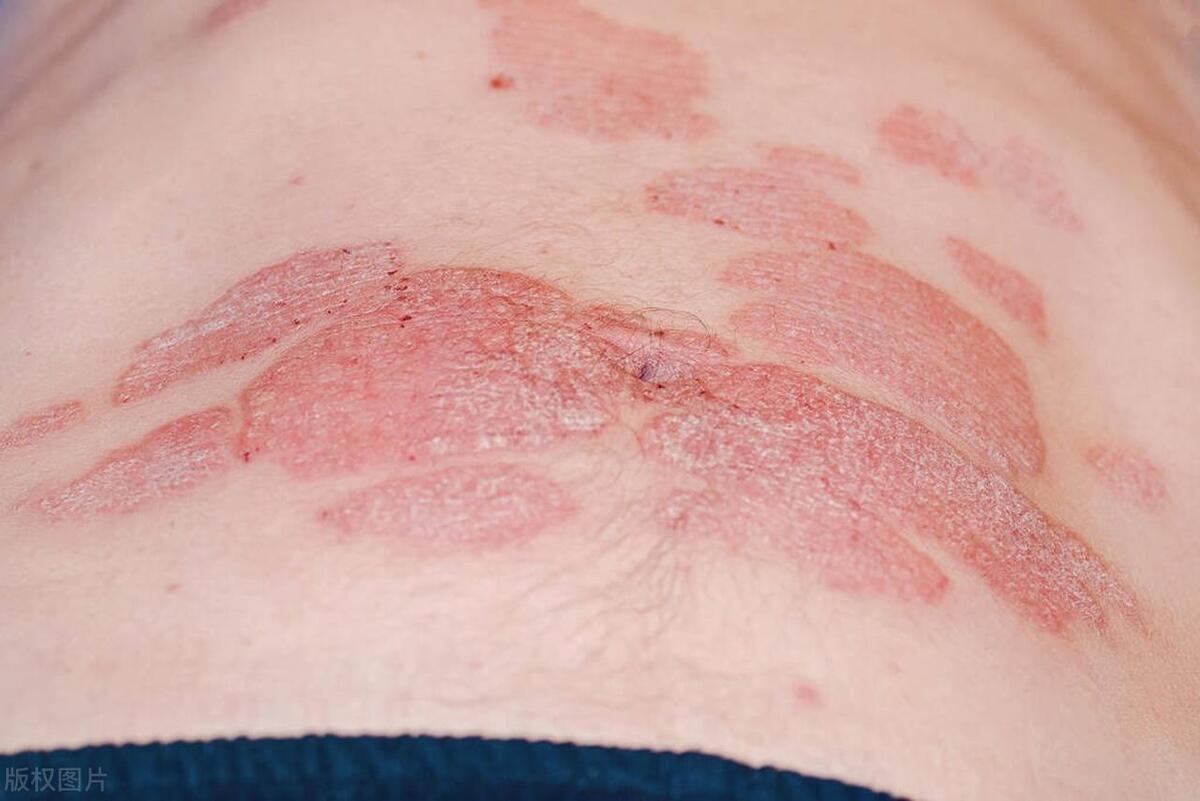 得了慢性湿疹该注意什么,慢性湿疹持续发作如何除根