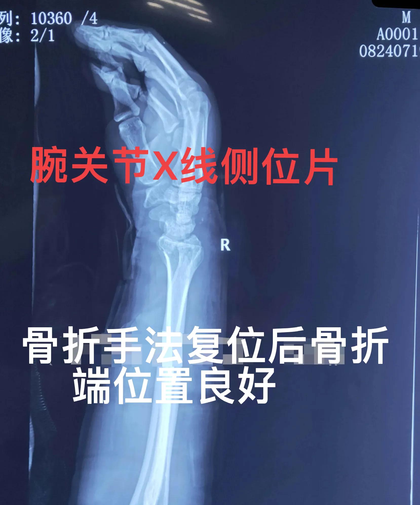 老年人腕部骨折手法复位石膏固定治疗方法指导