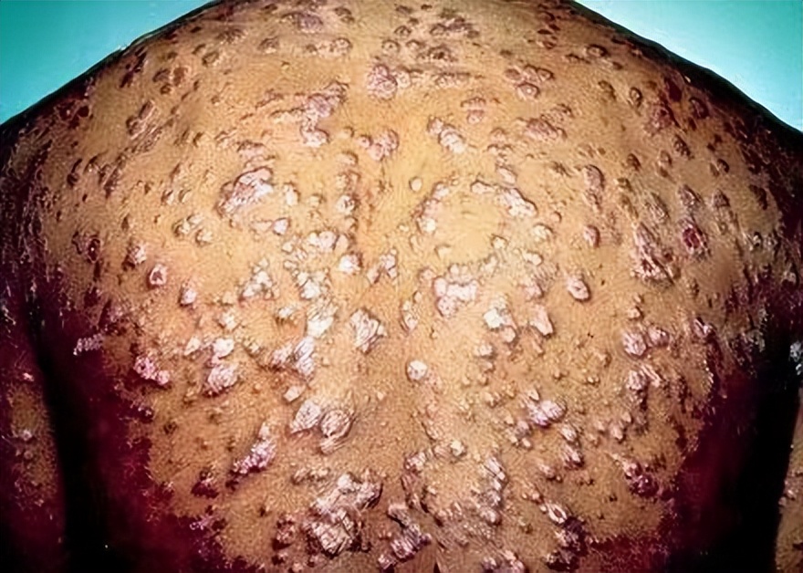 日本梅毒感染人数激增的原因,日本梅毒的症状