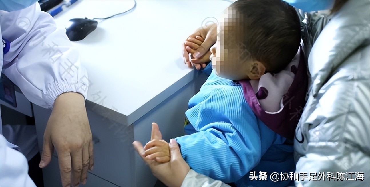 婴儿大拇指畸形怎么矫正,宝宝畸形手指