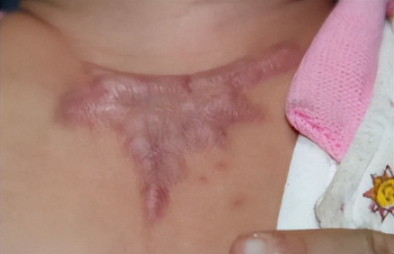 烧烫伤疤痕与硬损伤性疤痕的区别,烫伤疤痕好了可以用芦荟祛疤痕吗