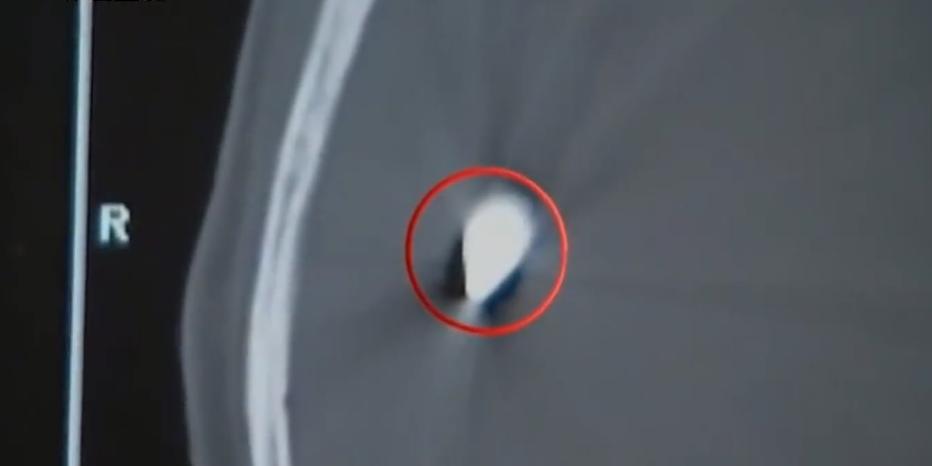 故事:江苏70岁老人头疼欲裂,检查时发现颅内有*弹子**,吓坏在场医生