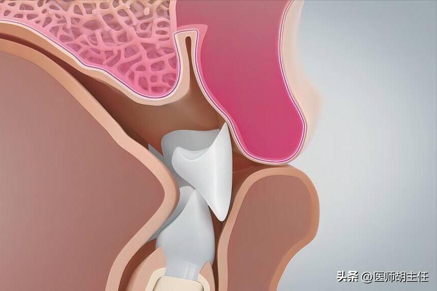 在牙缝里的牙结石要怎么去除,牙缝的牙结石怎么自己去除