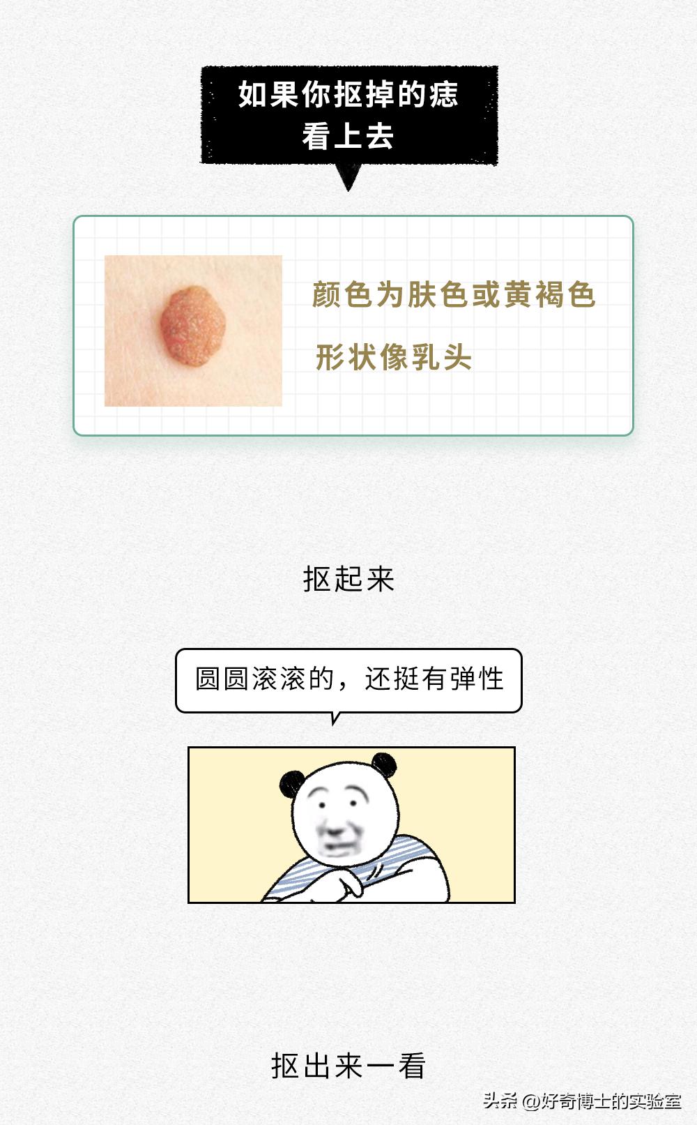 身上的痣被抠掉了会发生什么事情,身体上的痣可以抠掉吗