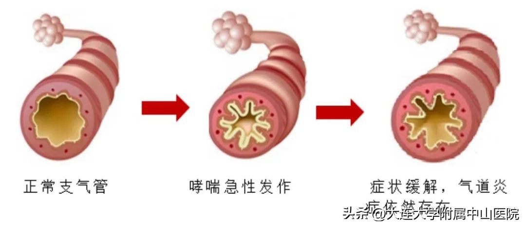 世界哮喘日关爱每一位哮喘患者,世界哮喘日关注儿童哮喘