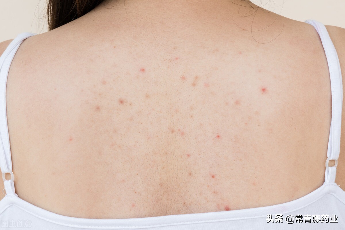 前胸后背长丘疹是毛囊炎,前胸后背长毛囊炎痘痘