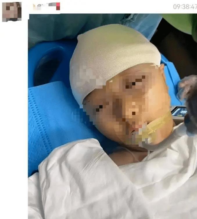 老师在小学时被女生狠狠打得头骨都碎了，需要动颅骨手术！