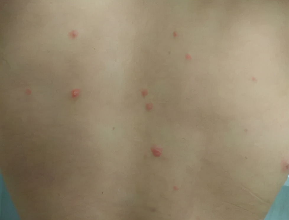 脸上起疹子擦宝宝霜,最近曝光的宝宝霜