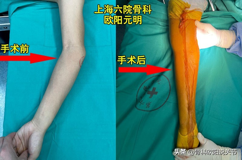 肘内翻能治什么病,肘内翻哪个医生做的好