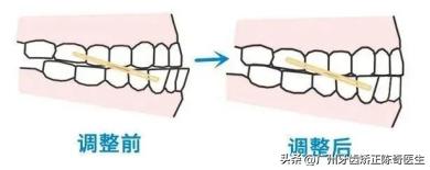 牙齿矫正橡皮筋怎么挂的,牙齿矫正橡皮筋用什么挂