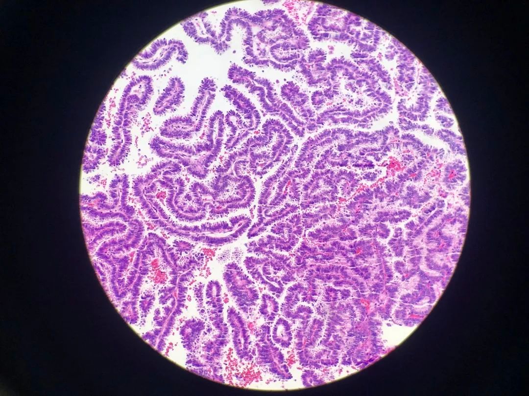 医生说病理报告有点小问题,病理报告没出来好害怕啊