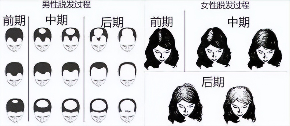 激光生发仪排名第一的,激光生发帽真的有用吗