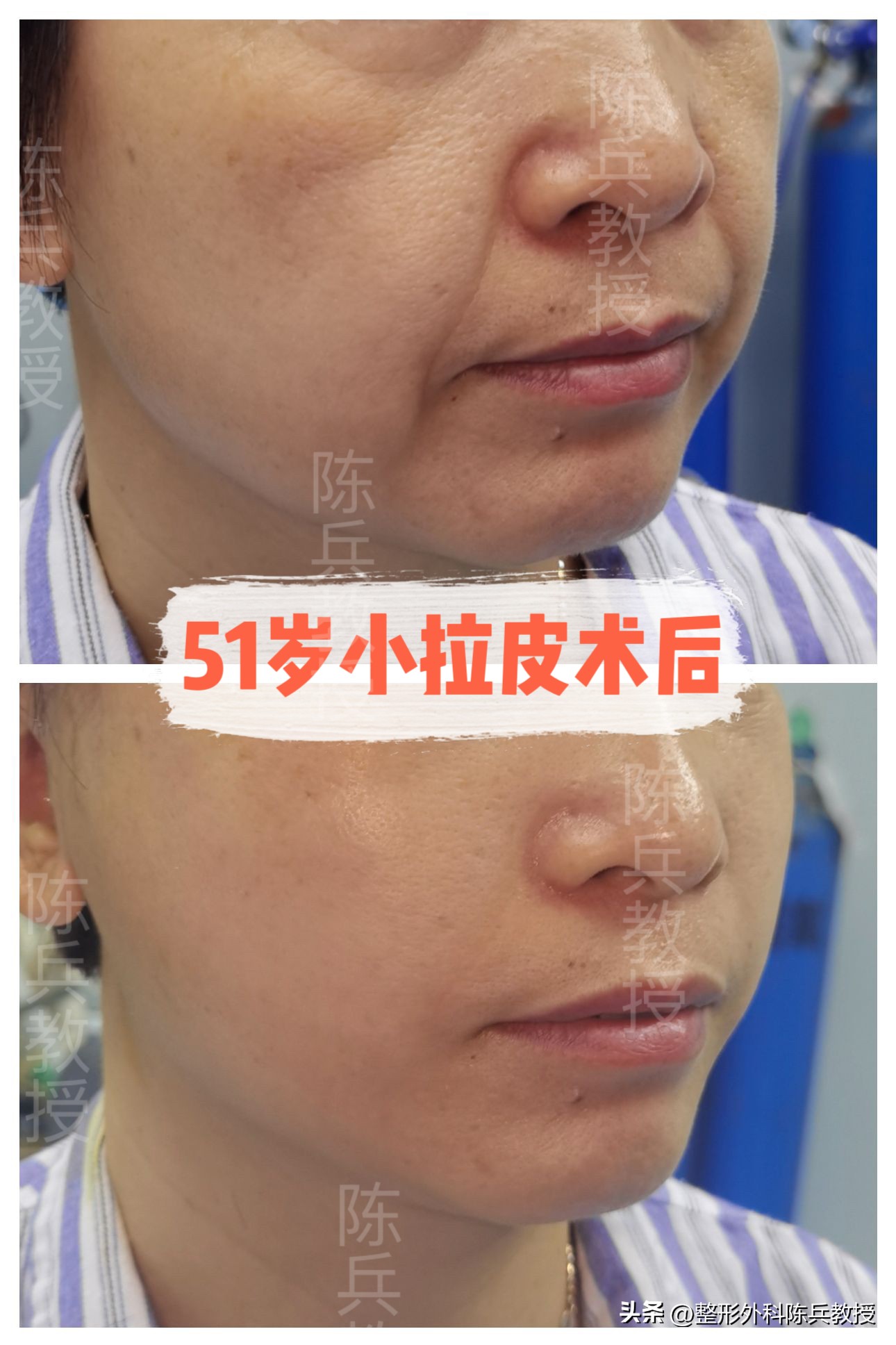 线雕面部提升跟拉皮哪个效果好,面部线雕和面部拉皮应该选哪个好