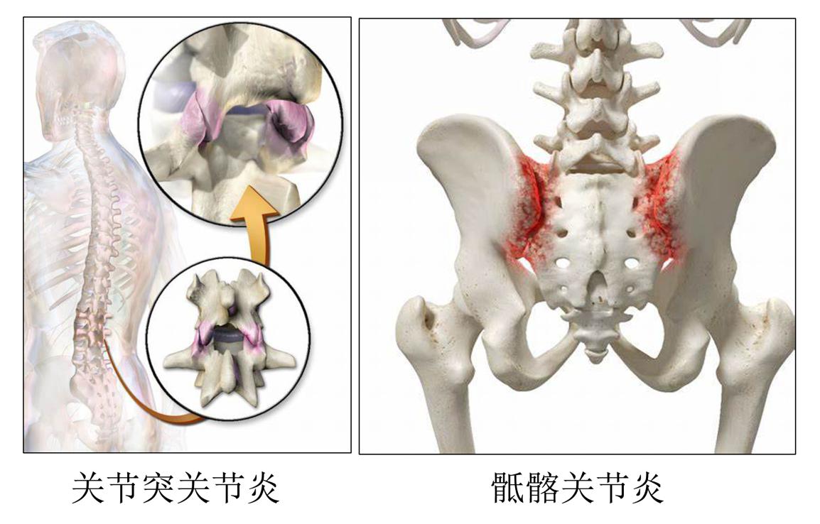 腰痛原因讲解,腰痛康复科普文章内容