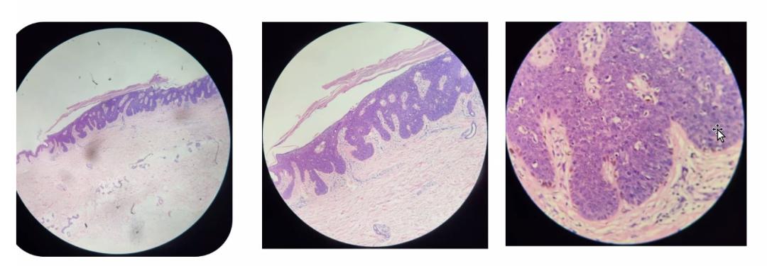 尖锐性湿疣是hpv高危感染吗,尖锐性湿疣和hpv哪个更严重