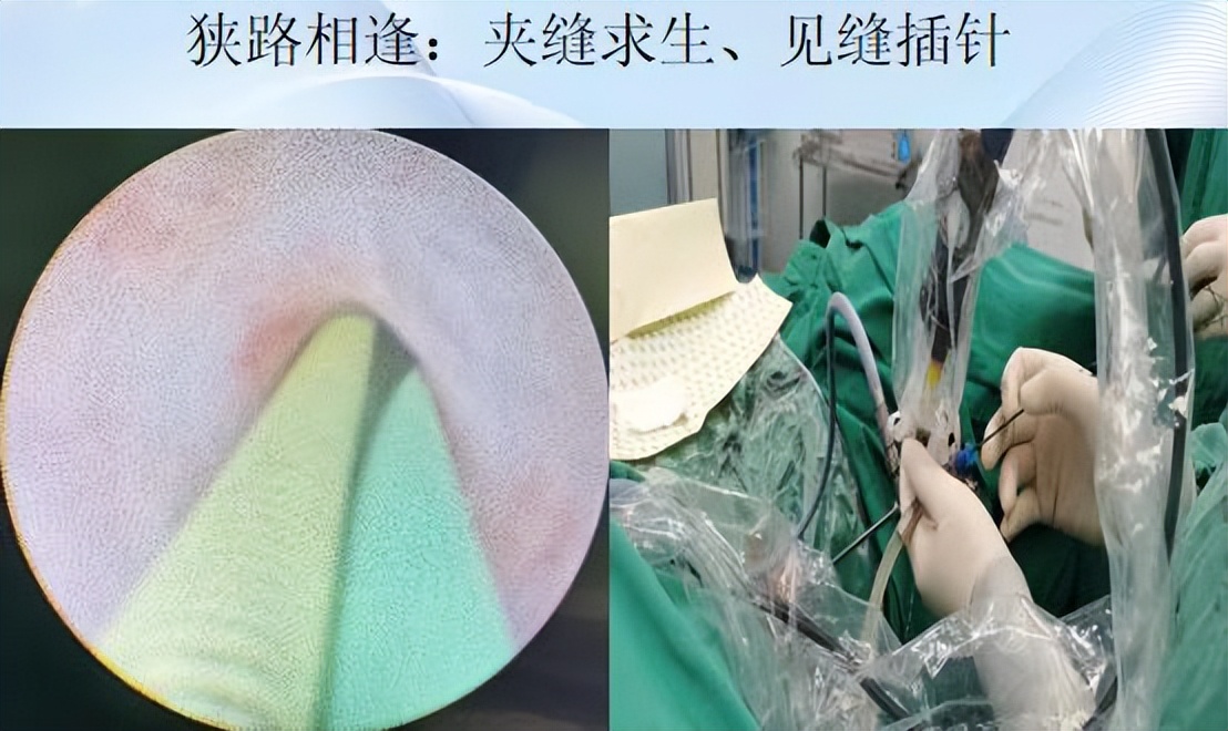 明知山有虎,偏向虎山行——肾斗士VS肾结石