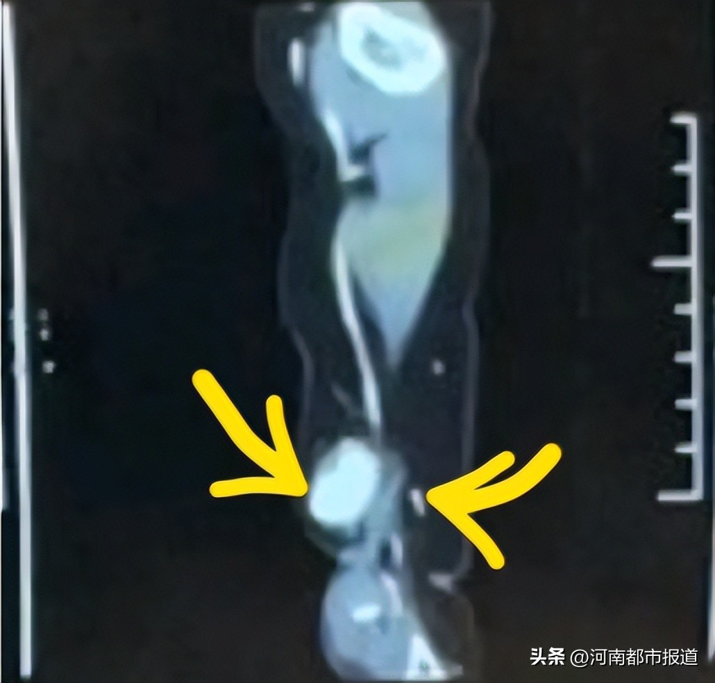 宝宝坠床摔出“动脉瘤”，回老家河南千里寻医