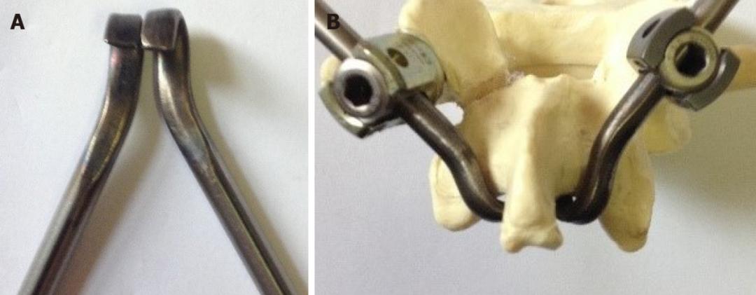 峡部裂和隐性峡部裂有区别吗,单纯峡部裂可以做峡部修复吗