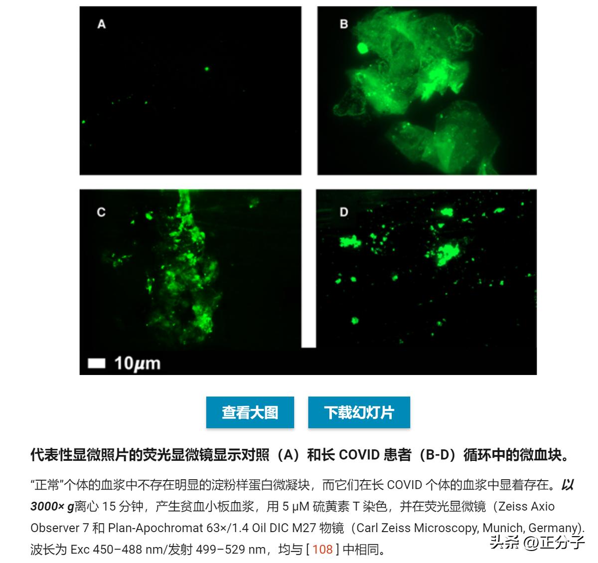 新冠引起间质性改变,新冠后遗症引起淀粉样变性