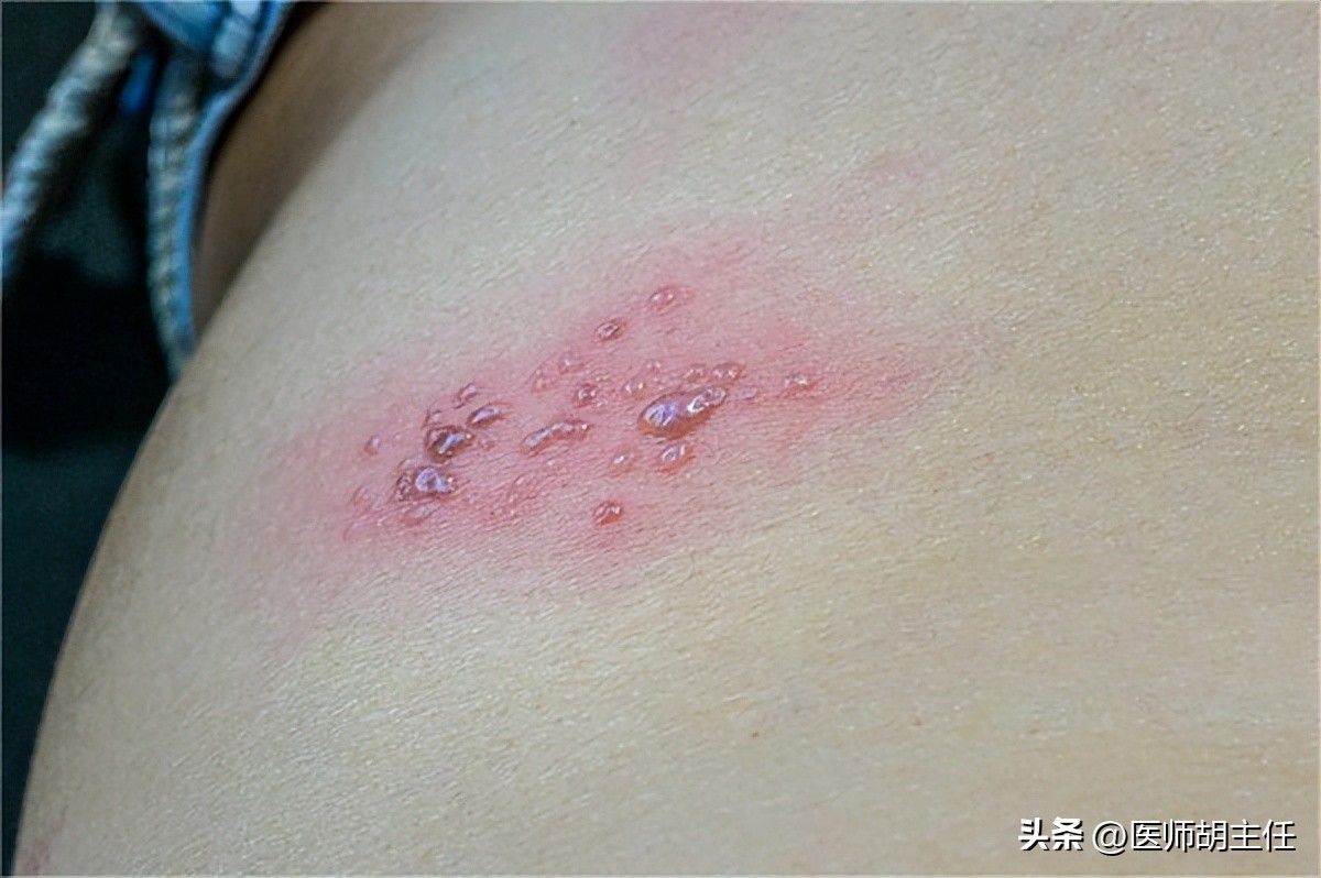 皮肤病带状疱疹用什么药好得快,带状疱疹最佳治疗方法