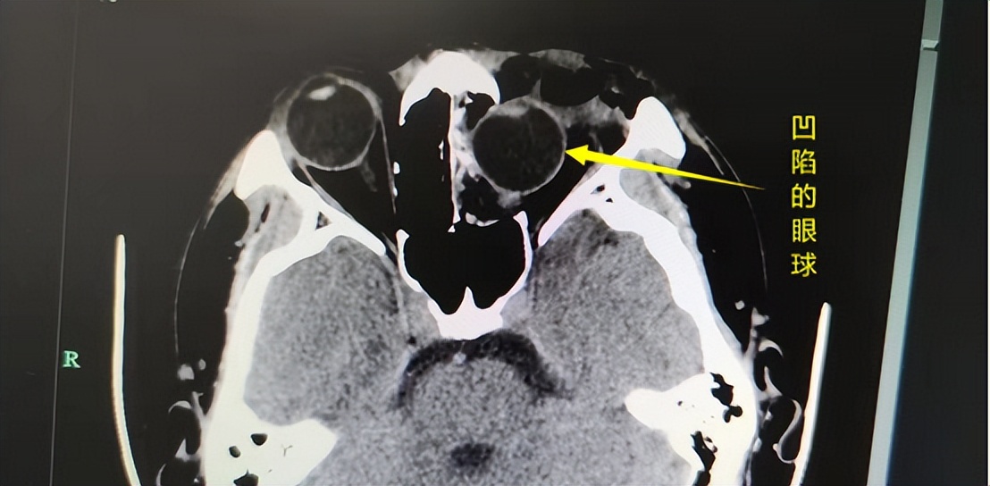 男子被砸脸眼球陷进鼻腔,男子鼻子被手机砸后屏幕却现凹坑