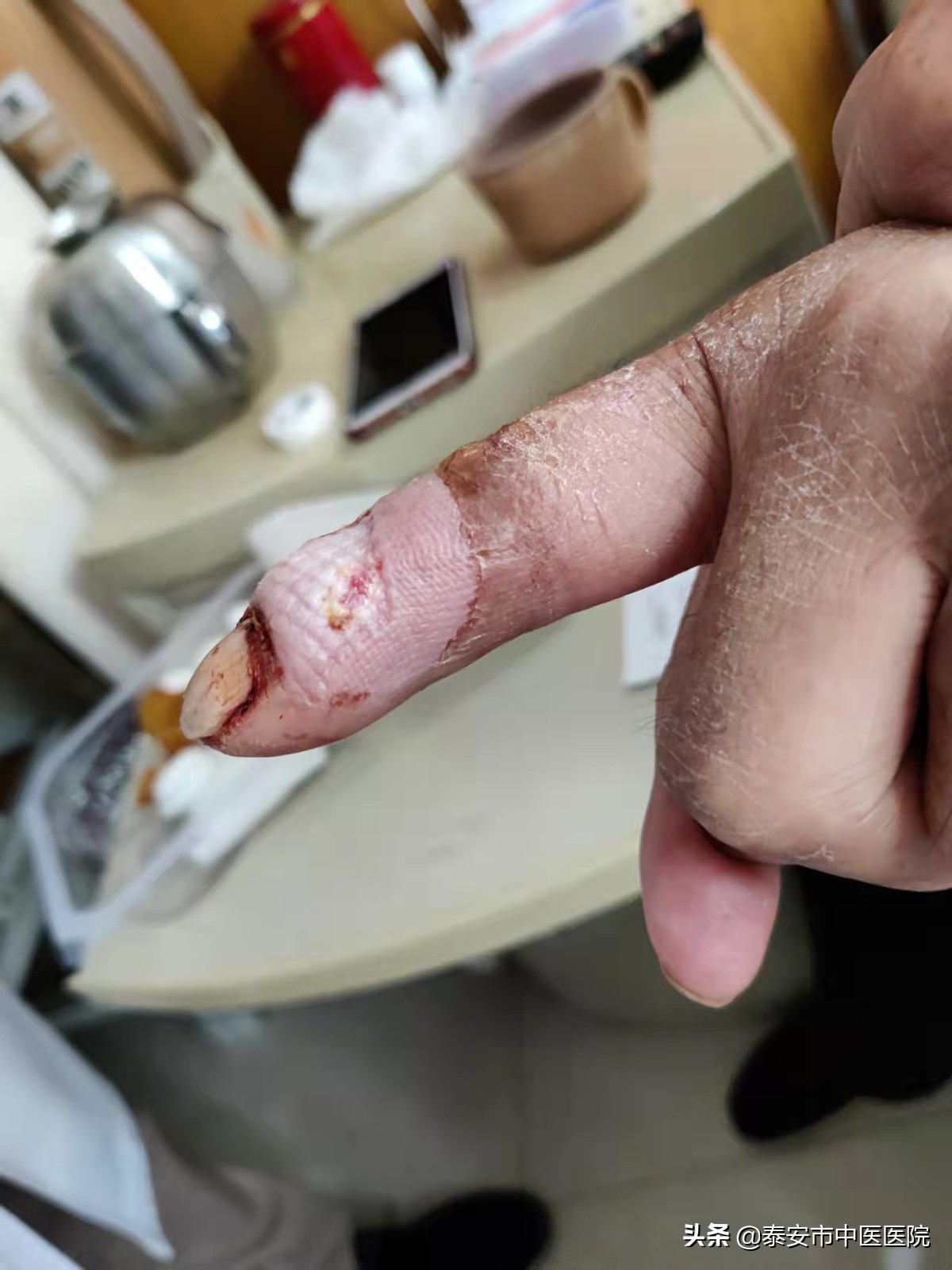 微创技术治疗疼痛,微创手术除病痛