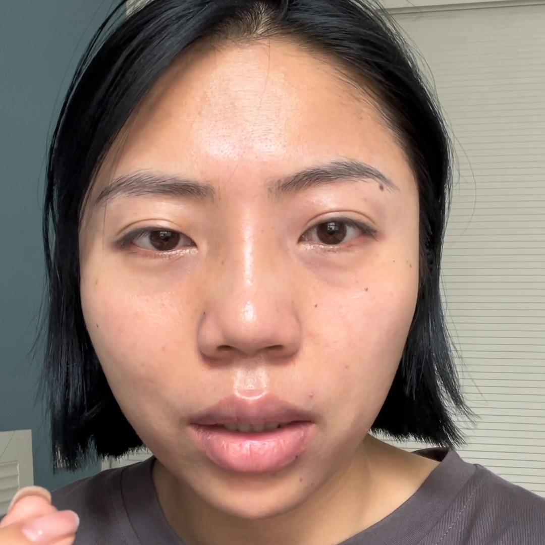 鼻子术后五个月了山根还是高,做完鼻子恢复后发现山根歪的